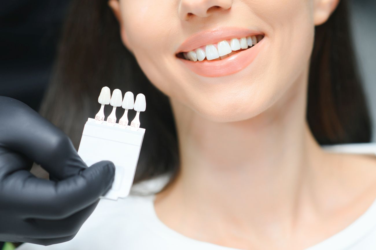 Czym jest bonding na zęby i ile kosztuje? - Magazyn Drogeria